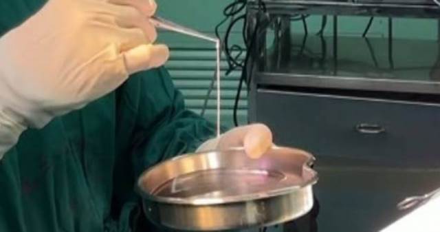 男21年不敢獨自出門！驚悚病因曝光　腦中夾出「10公分活蟲」